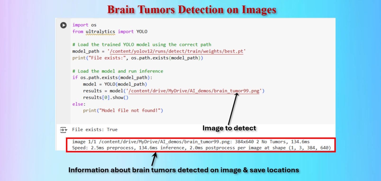 brain tumor detected 