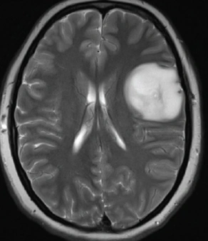 Before Detection 2